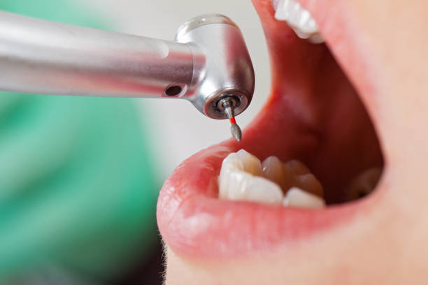 Best Chipped Tooth Repair Near Me  in Shady Point, OK